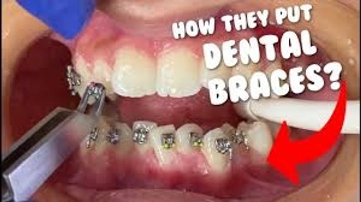 Beginner’s Guide: What Are Dental Clips and How Do They Work?