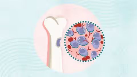Myeloma Insights: Latest Advances in Diagnosis and Treatment Options