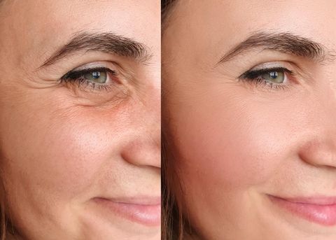 Crow's Feet Treatment Overview: Important Details About Modern Anti-Aging Approaches